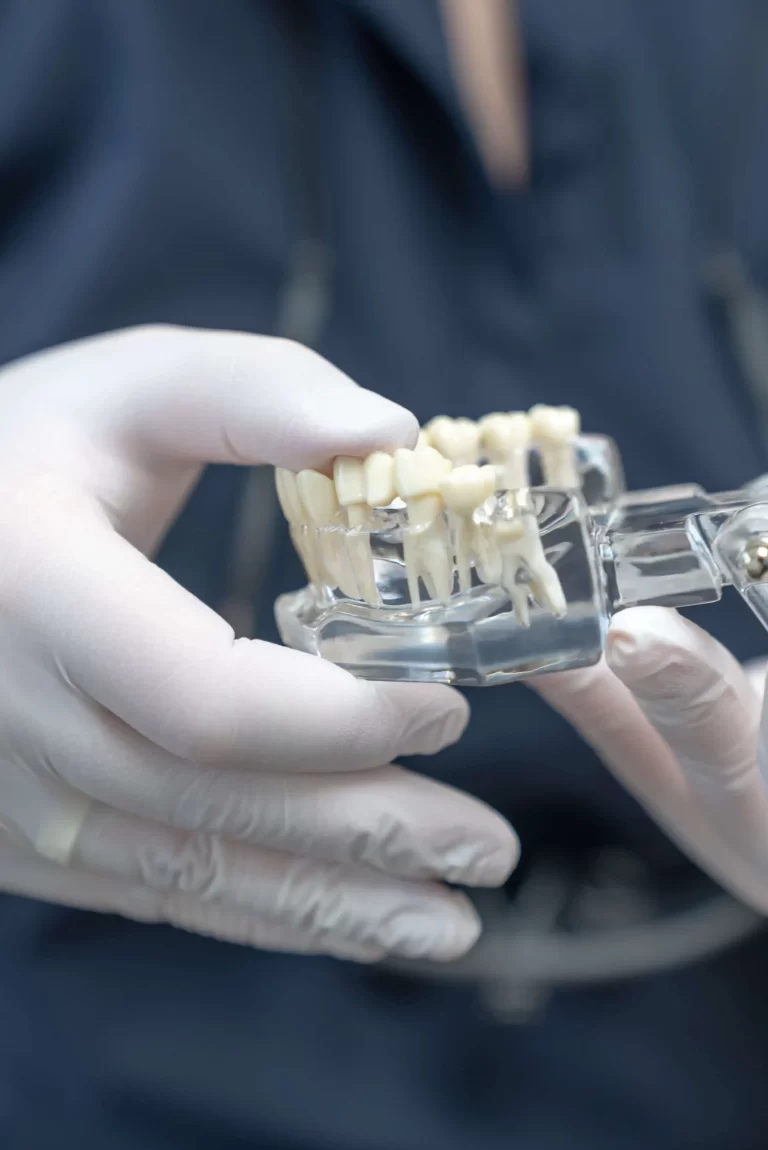 Removable denture bridge