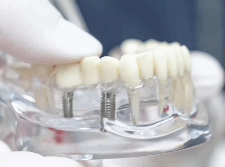 Illustration von Zahnimplantaten